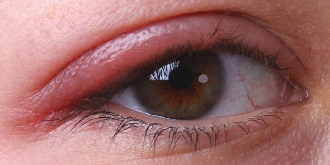 Dlaczego swędzące oczy: zapalenie powiek