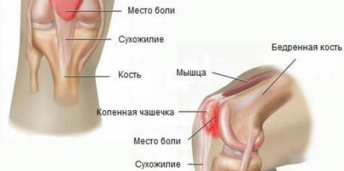 Dlaczego bolą kolana: zespół bólowy rzepkowo