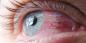 Zapalenie spojówek: dlaczego czerwienić oczy i jak je leczyć