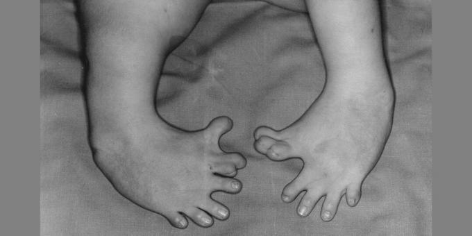 Deformacja nóg noworodka, którego matka przyjmowała talidomid. Skutki uboczne leku nazywane są przykładem działań Big Pharma.