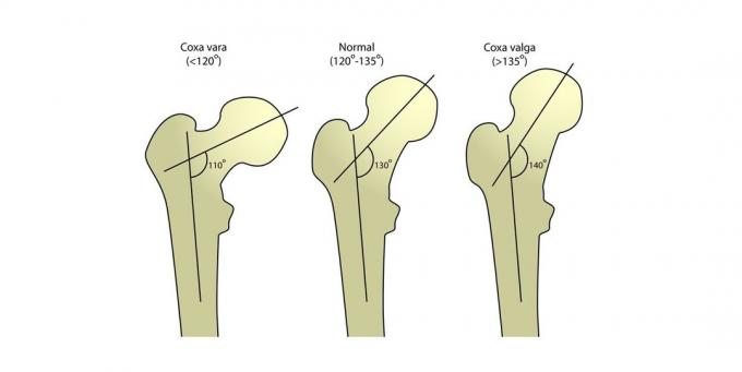 Szyjki kości udowej: kąt