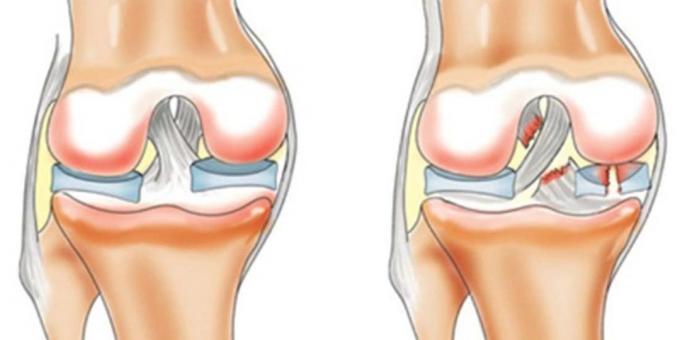 Dlaczego boli kolana: zerwanie więzadła krzyżowego przedniego