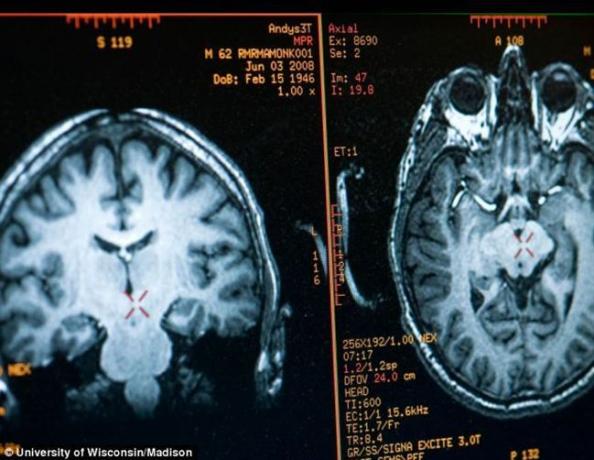 Mózg Mathieu Ricard obraz uzyskany za pomocą MRI