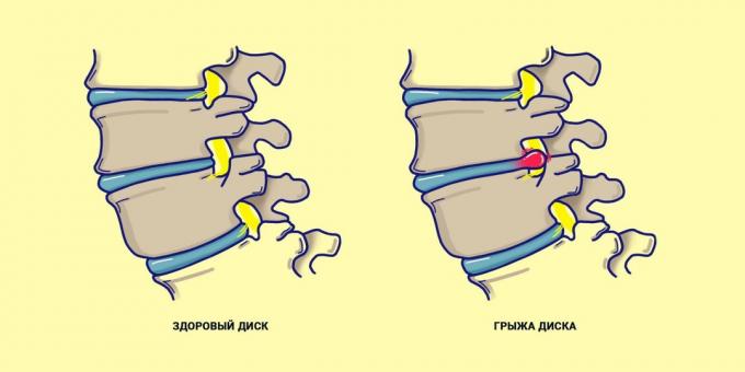 Przepuklina kręgosłupa w porównaniu ze zdrową tyłu