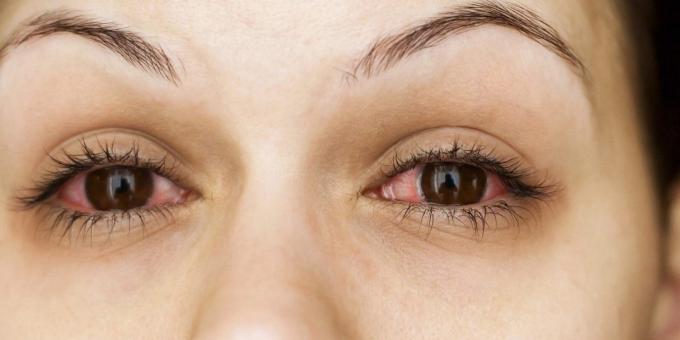 Dlaczego swędzenie oczu, zapalenie spojówek