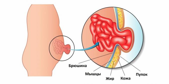 Przepuklina pępkowa