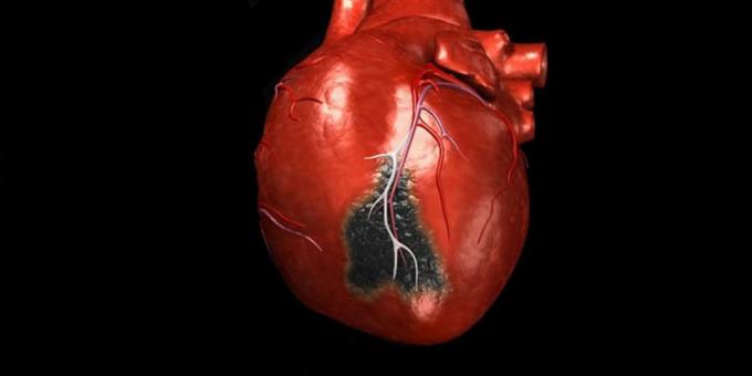Objawy zawału serca, dla których trzeba wezwać karetkę