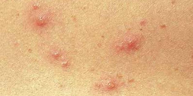 Objawy ospy wietrznej u dzieci i dorosłych: Dość często, skóra natychmiast pojawiają się małe czerwone kropki
