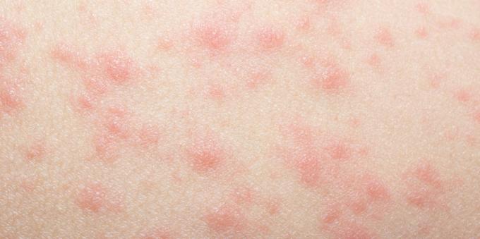 Wysypka skórna z alergiami na leki